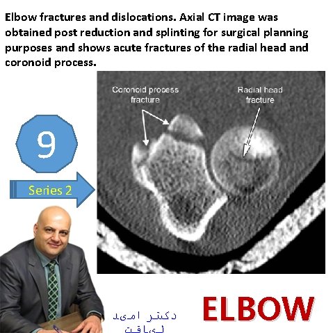 Elbow fractures and dislocations. Axial CT image was obtained post reduction and splinting for
