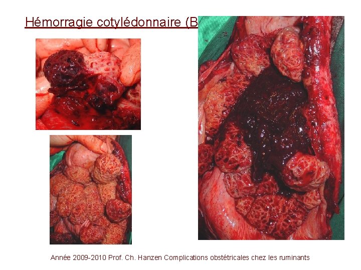 Hémorragie cotylédonnaire (BBB J+1) Année 2009 -2010 Prof. Ch. Hanzen Complications obstétricales chez les