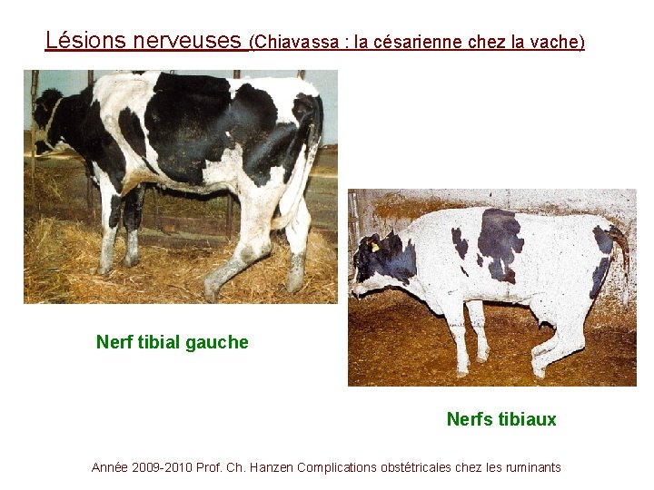 Lésions nerveuses (Chiavassa : la césarienne chez la vache) Nerf tibial gauche Nerfs tibiaux