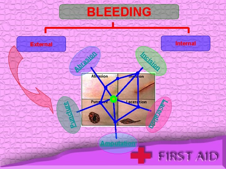 BLEEDING Internal External In ci si on n io as r b A r