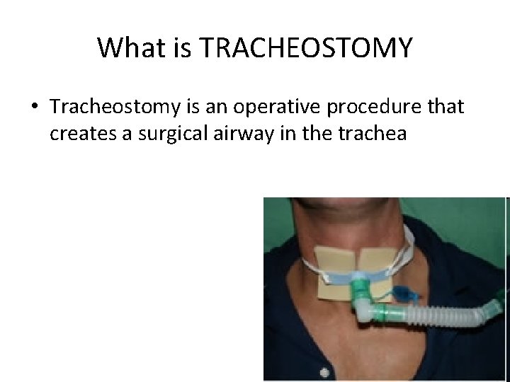 What is TRACHEOSTOMY • Tracheostomy is an operative procedure that creates a surgical airway What is TRACHEOSTOMY • Tracheostomy is an operative procedure that creates a surgical airway