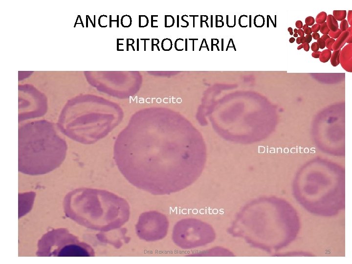 ANCHO DE DISTRIBUCION ERITROCITARIA Dra. Roxana Blanco Villarte 25 ANCHO DE DISTRIBUCION ERITROCITARIA Dra. Roxana Blanco Villarte 25