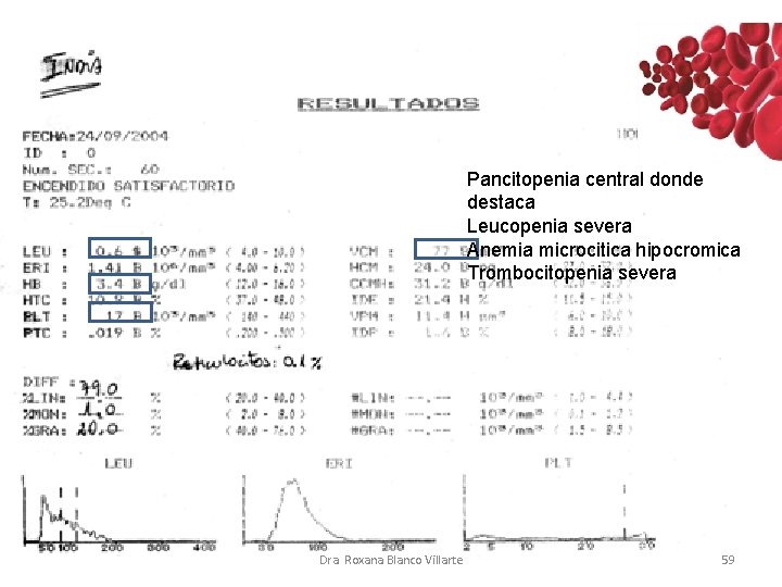 Pancitopenia central donde destaca Leucopenia severa Anemia microcitica hipocromica Trombocitopenia severa Dra. Roxana Blanco Pancitopenia central donde destaca Leucopenia severa Anemia microcitica hipocromica Trombocitopenia severa Dra. Roxana Blanco