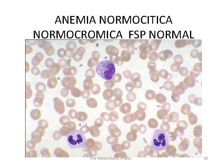 ANEMIA NORMOCITICA NORMOCROMICA FSP NORMAL Dra. Roxana Blanco Villarte 65 ANEMIA NORMOCITICA NORMOCROMICA FSP NORMAL Dra. Roxana Blanco Villarte 65