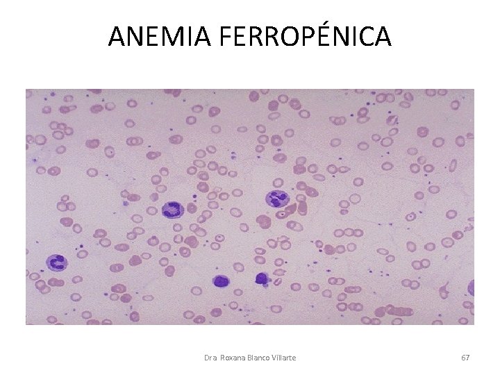 ANEMIA FERROPÉNICA Dra. Roxana Blanco Villarte 67 ANEMIA FERROPÉNICA Dra. Roxana Blanco Villarte 67
