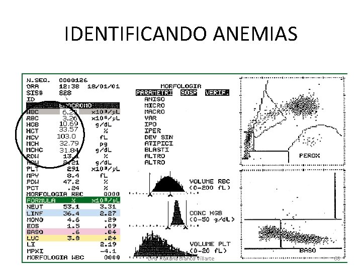 IDENTIFICANDO ANEMIAS Dra. Roxana Blanco Villarte 68 IDENTIFICANDO ANEMIAS Dra. Roxana Blanco Villarte 68