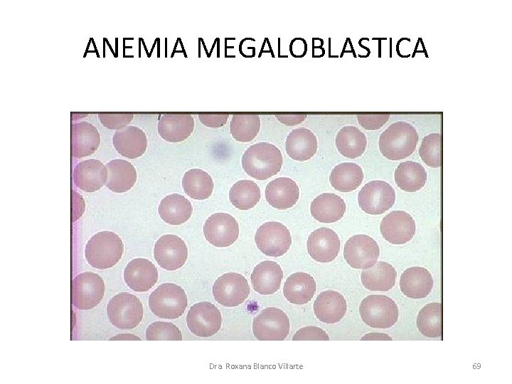 ANEMIA MEGALOBLASTICA Dra. Roxana Blanco Villarte 69 ANEMIA MEGALOBLASTICA Dra. Roxana Blanco Villarte 69
