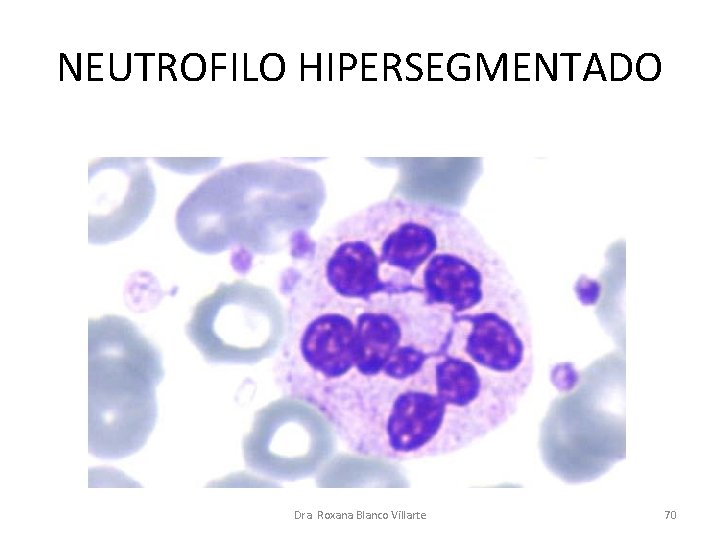 NEUTROFILO HIPERSEGMENTADO Dra. Roxana Blanco Villarte 70 NEUTROFILO HIPERSEGMENTADO Dra. Roxana Blanco Villarte 70