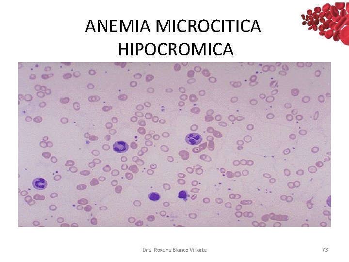 ANEMIA MICROCITICA HIPOCROMICA Dra. Roxana Blanco Villarte 73 ANEMIA MICROCITICA HIPOCROMICA Dra. Roxana Blanco Villarte 73