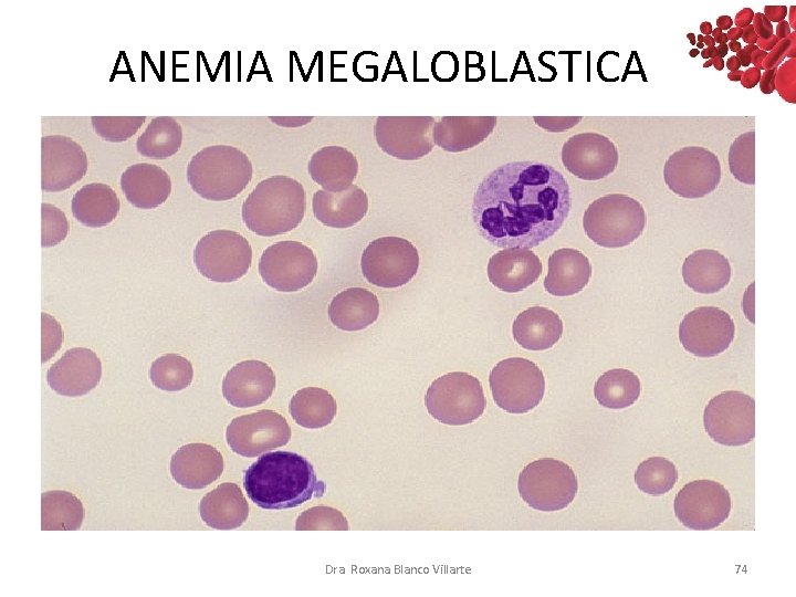 ANEMIA MEGALOBLASTICA Dra. Roxana Blanco Villarte 74 ANEMIA MEGALOBLASTICA Dra. Roxana Blanco Villarte 74