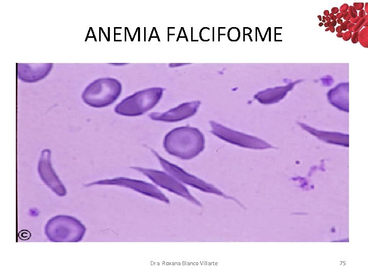 ANEMIA FALCIFORME Dra. Roxana Blanco Villarte 75 ANEMIA FALCIFORME Dra. Roxana Blanco Villarte 75