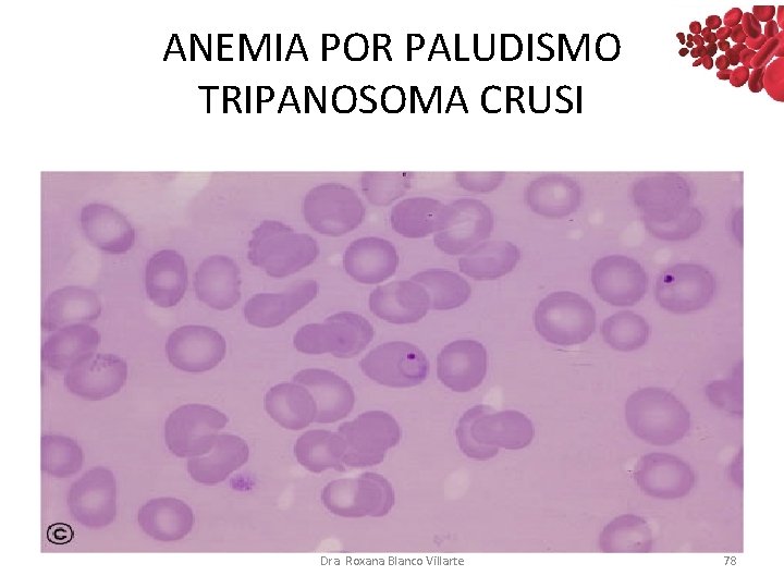 ANEMIA POR PALUDISMO TRIPANOSOMA CRUSI Dra. Roxana Blanco Villarte 78 ANEMIA POR PALUDISMO TRIPANOSOMA CRUSI Dra. Roxana Blanco Villarte 78