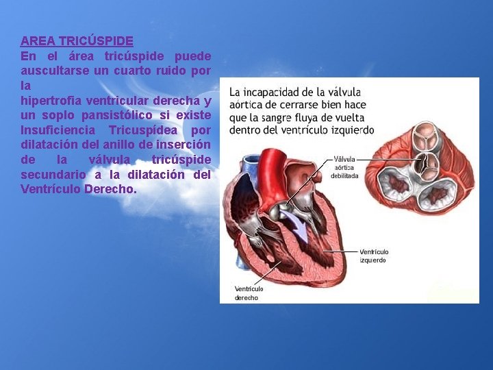 AREA TRICÚSPIDE En el área tricúspide puede auscultarse un cuarto ruido por la hipertrofia