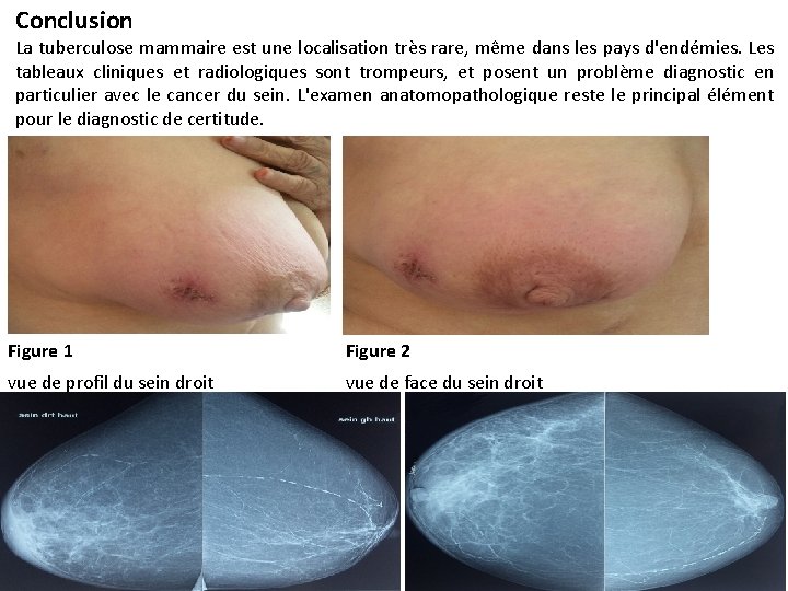 Conclusion La tuberculose mammaire est une localisation très rare, même dans les pays d'endémies.