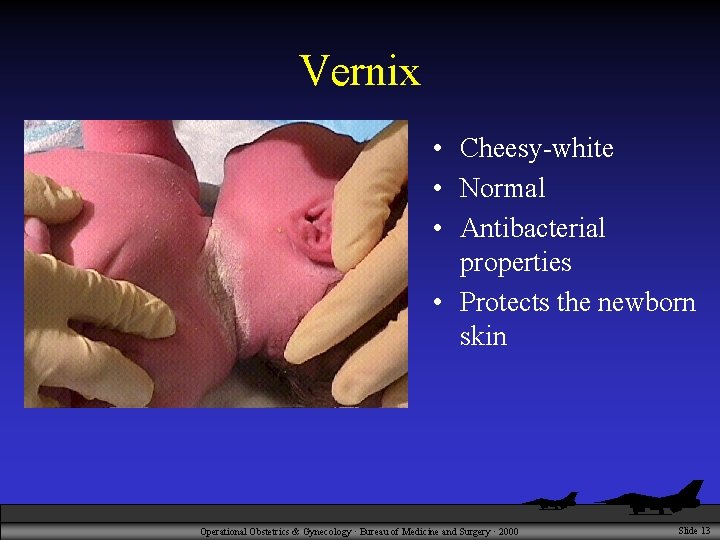 Vernix • Cheesy-white • Normal • Antibacterial properties • Protects the newborn skin Operational