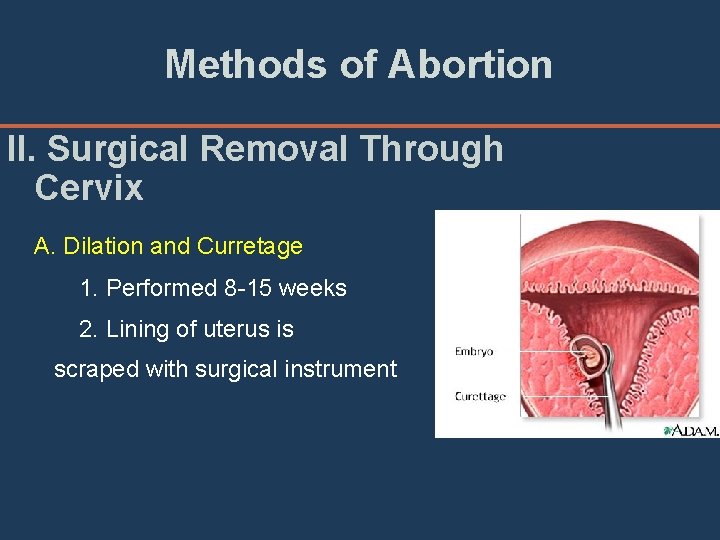 Methods of Abortion II. Surgical Removal Through Cervix A. Dilation and Curretage 1. Performed