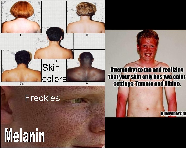 Tanning Skin colors Freckles Moles 