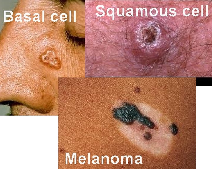 Basal cell Squamous cell Melanoma 