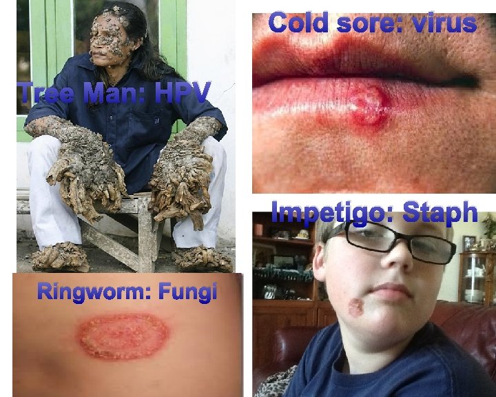 Cold sore: virus Tree Man: HPV Impetigo: Staph Ringworm: Fungi 