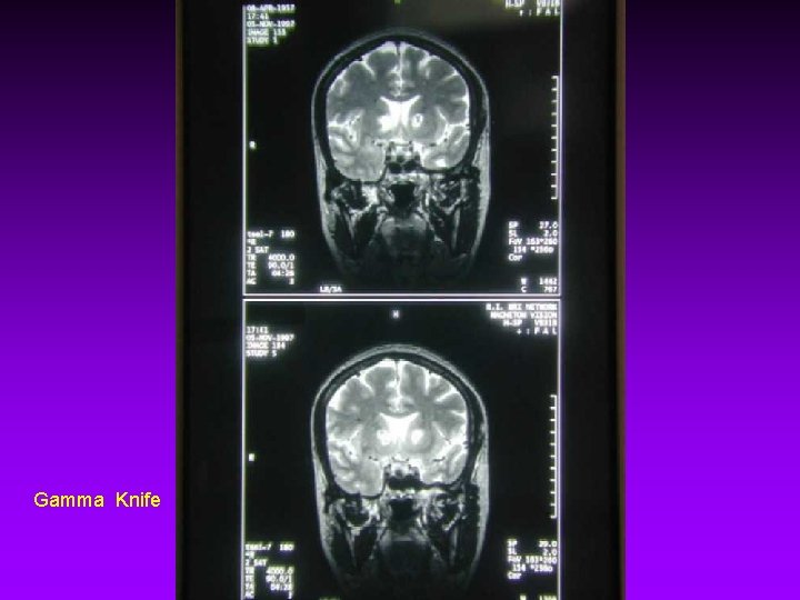 Gamma Knife 