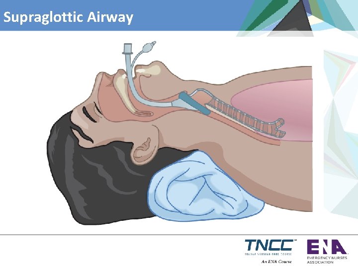 Supraglottic Airway 