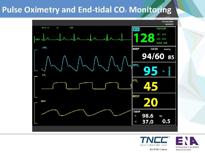 Pulse Oximetry and End-tidal CO Monitoring 2 