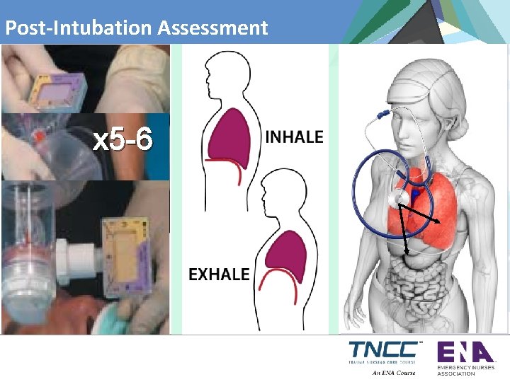 Post-Intubation Assessment 1 2 3 x 5 -6 