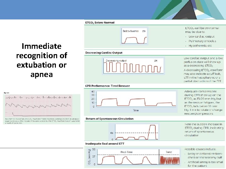 Immediate recognition of extubation or apnea 