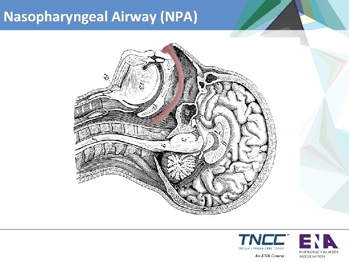 Nasopharyngeal Airway (NPA) 