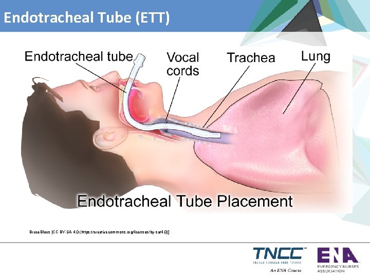 Endotracheal Tube (ETT) Bruce. Blaus [CC BY-SA 4. 0 (https: //creativecommons. org/licenses/by-sa/4. 0)] 
