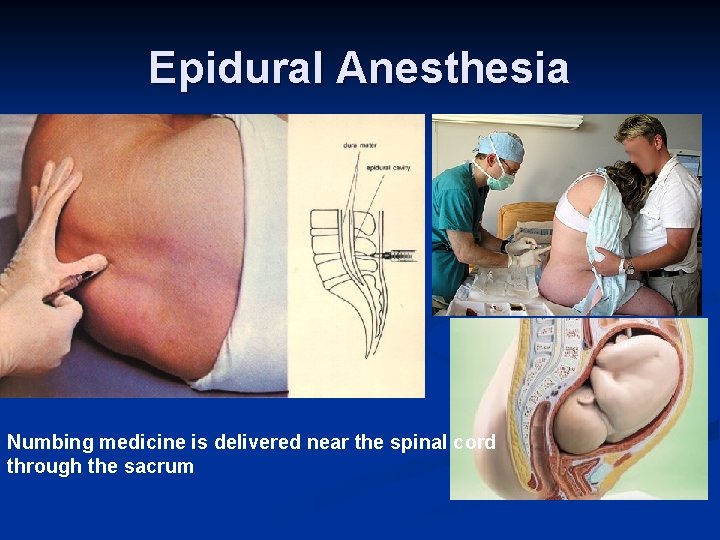 Epidural Anesthesia Numbing medicine is delivered near the spinal cord through the sacrum Epidural Anesthesia Numbing medicine is delivered near the spinal cord through the sacrum