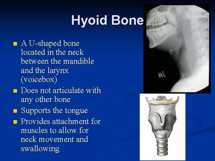 Hyoid Bone n n A U-shaped bone located in the neck between the mandible Hyoid Bone n n A U-shaped bone located in the neck between the mandible