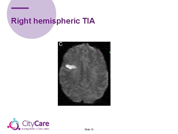 Right hemispheric TIA Slide 13 