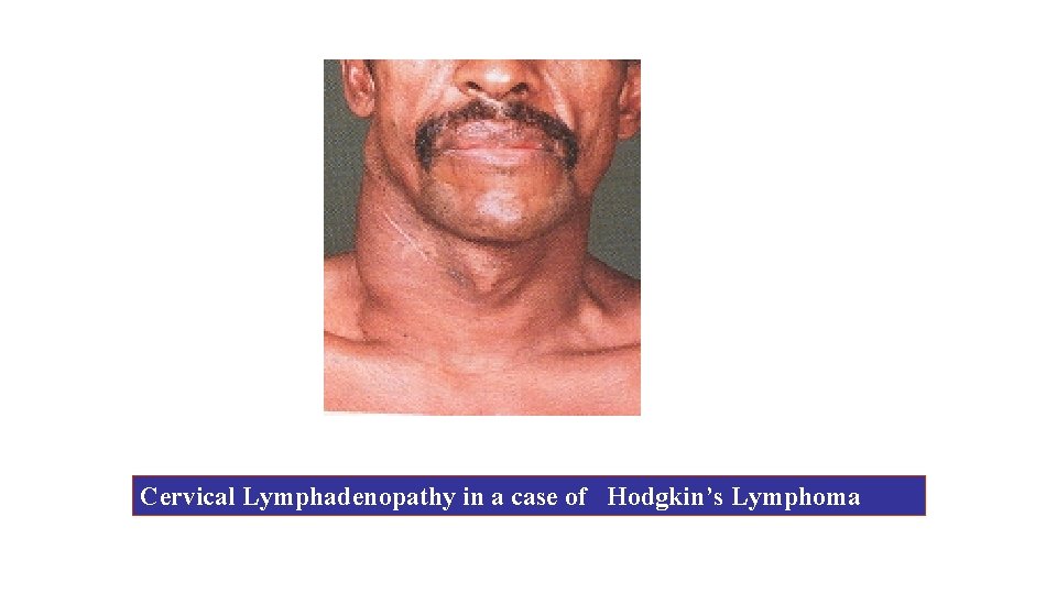 Cervical Lymphadenopathy in a case of Hodgkin’s Lymphoma 