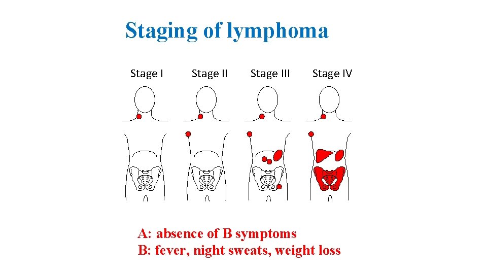 Staging of lymphoma Stage III Stage IV A: absence of B symptoms B: fever,