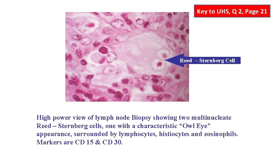 Key to UHS, Q 2, Page 21 Reed – Sternberg Cell High power view