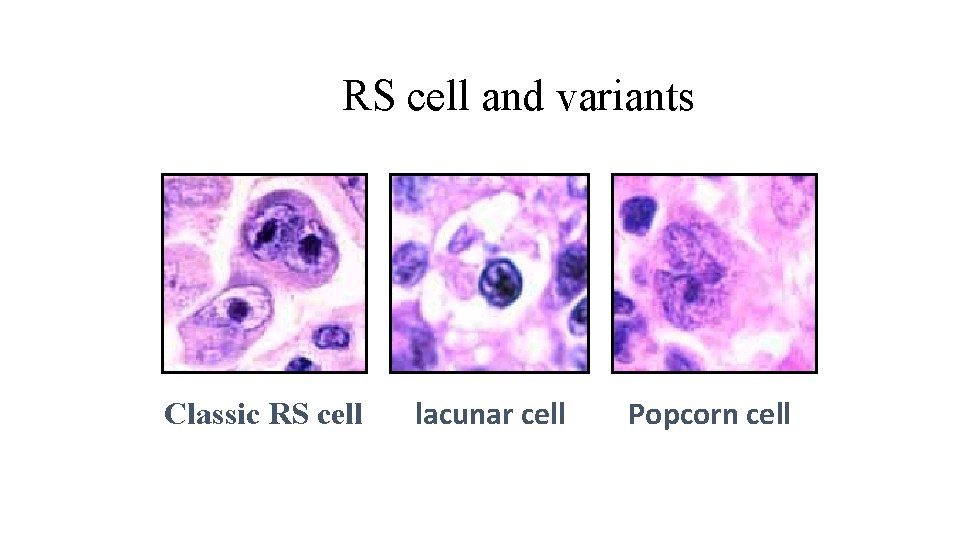 RS cell and variants Classic RS cell lacunar cell Popcorn cell 