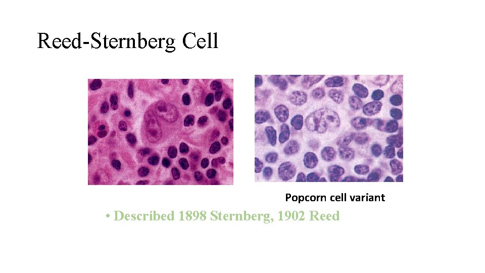 Reed-Sternberg Cell Popcorn cell variant • Described 1898 Sternberg, 1902 Reed 