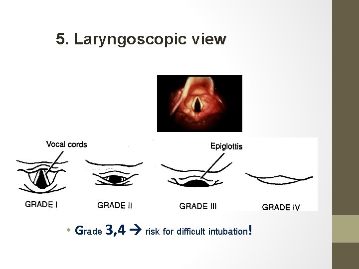 5. Laryngoscopic view • Grade 3, 4 risk for difficult intubation! 