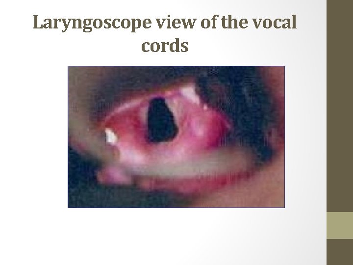 Laryngoscope view of the vocal cords 