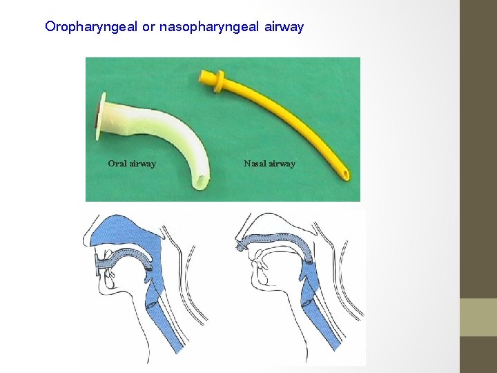 Oropharyngeal or nasopharyngeal airway Oral airway Nasal airway 