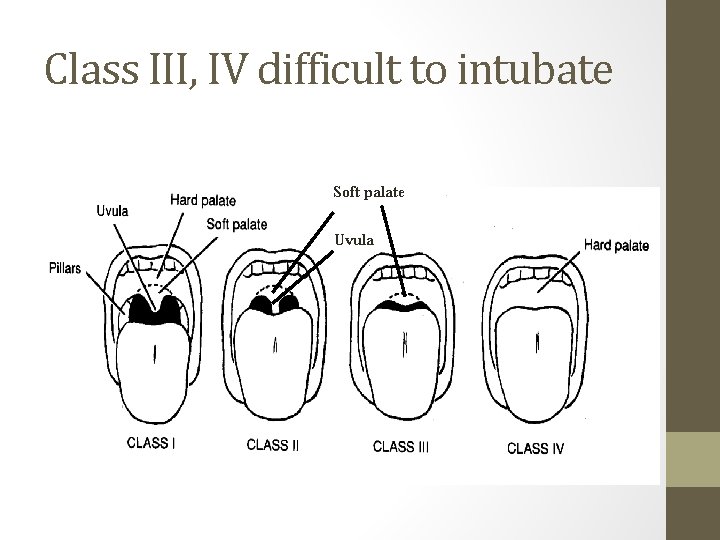 Class III, IV difficult to intubate Soft palate Uvula 