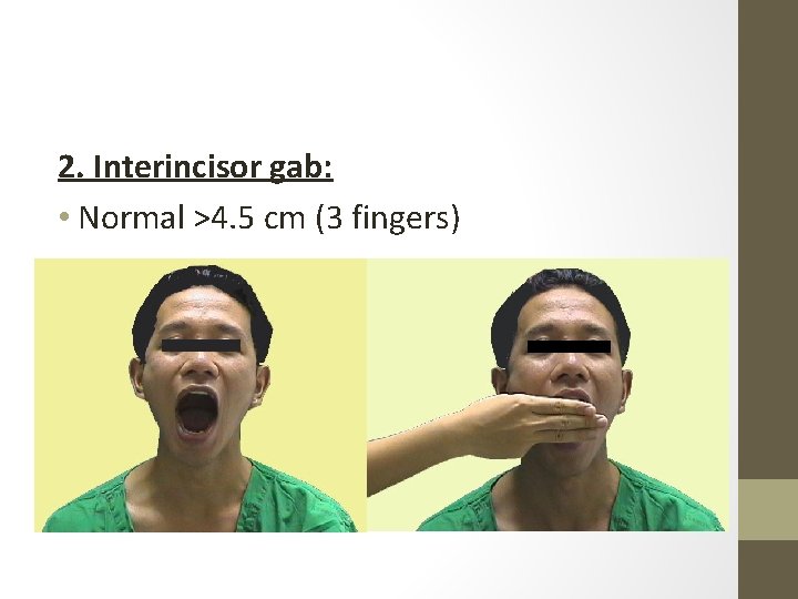 2. Interincisor gab: • Normal >4. 5 cm (3 fingers) 