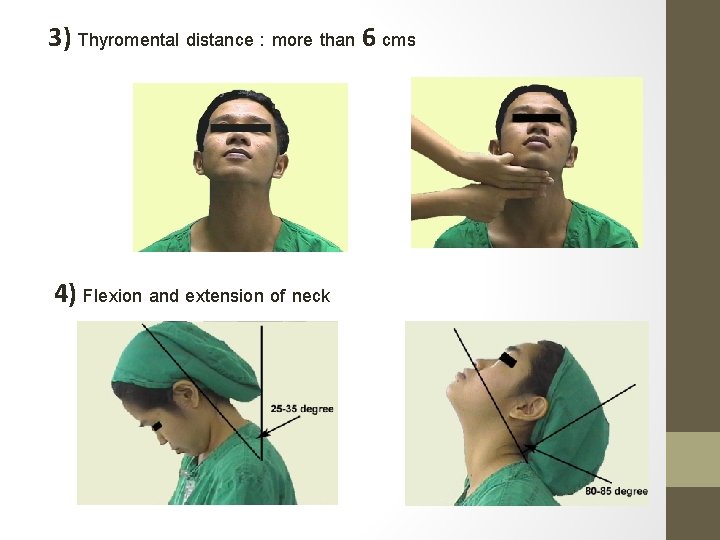 3) Thyromental distance : more than 6 cms 4) Flexion and extension of neck