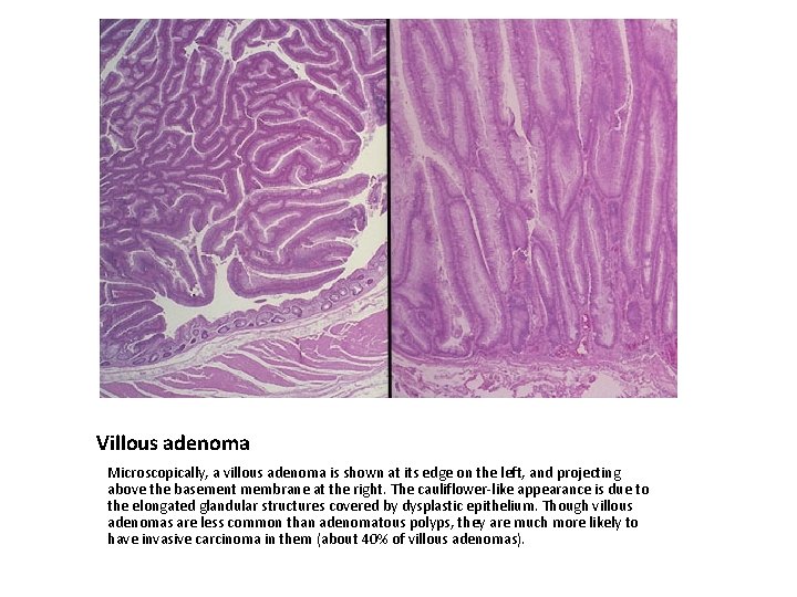 Villous adenoma Microscopically, a villous adenoma is shown at its edge on the left,