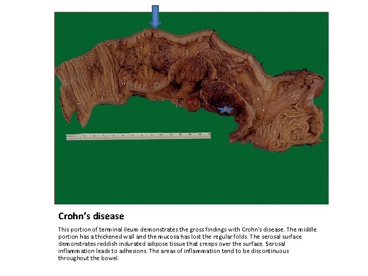 Crohn’s disease This portion of terminal ileum demonstrates the gross findings with Crohn's disease.
