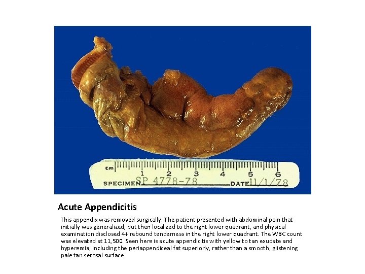 Acute Appendicitis This appendix was removed surgically. The patient presented with abdominal pain that