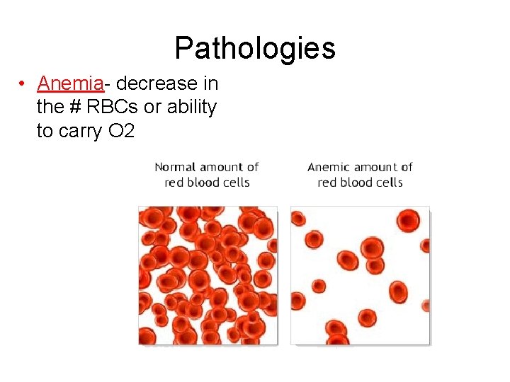 Pathologies • Anemia- decrease in the # RBCs or ability to carry O 2