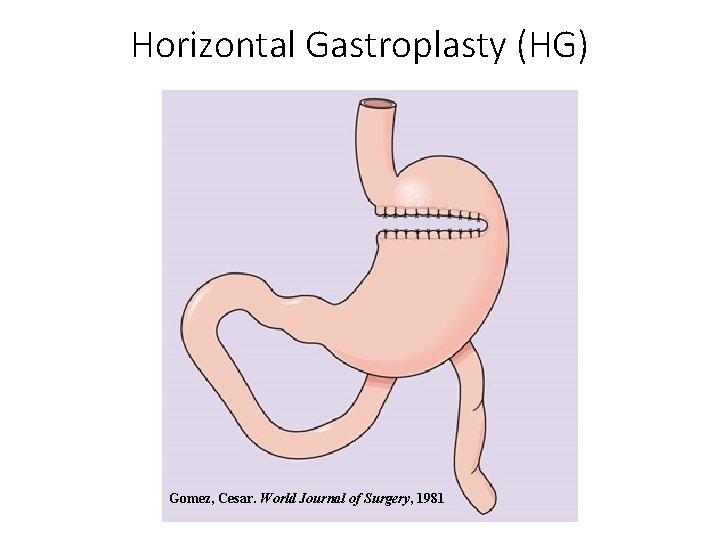 Horizontal Gastroplasty (HG) Gomez, Cesar. World Journal of Surgery, 1981 