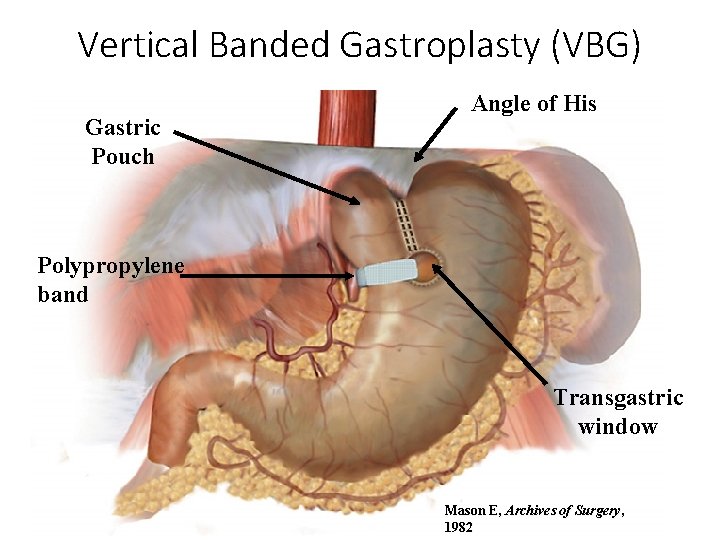 Vertical Banded Gastroplasty (VBG) Gastric Pouch Angle of His Polypropylene band Transgastric window Mason
